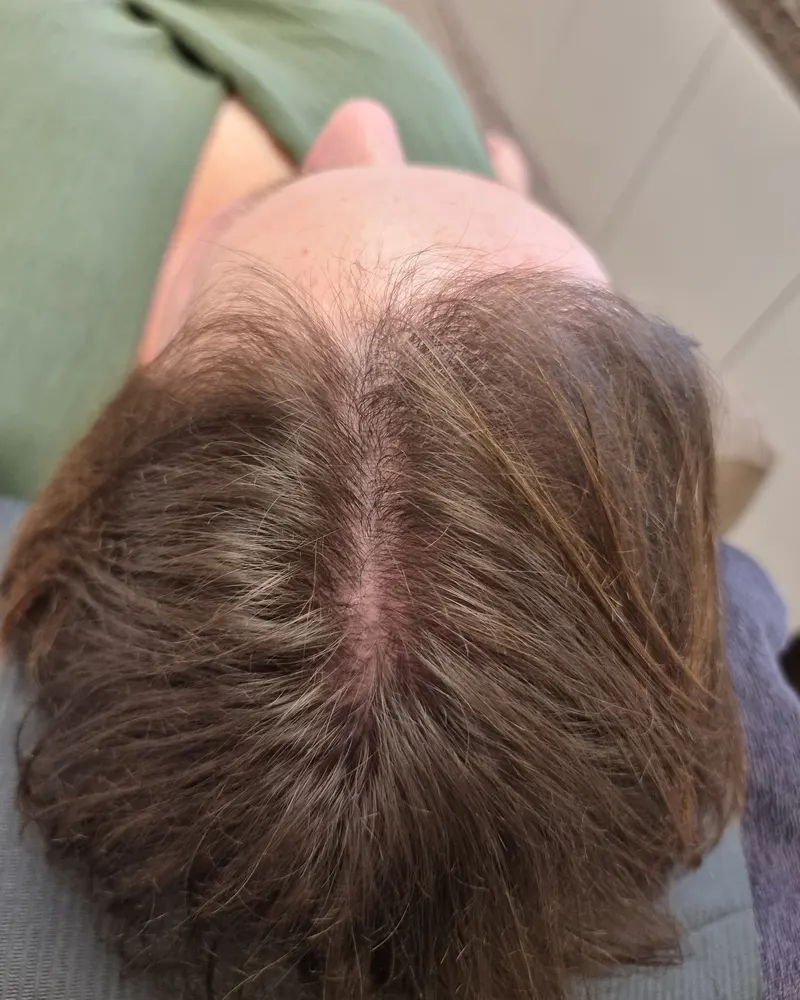 Dezelfde hoofdhuid na Micro Haar Pigmentatie, zichtbaar voller