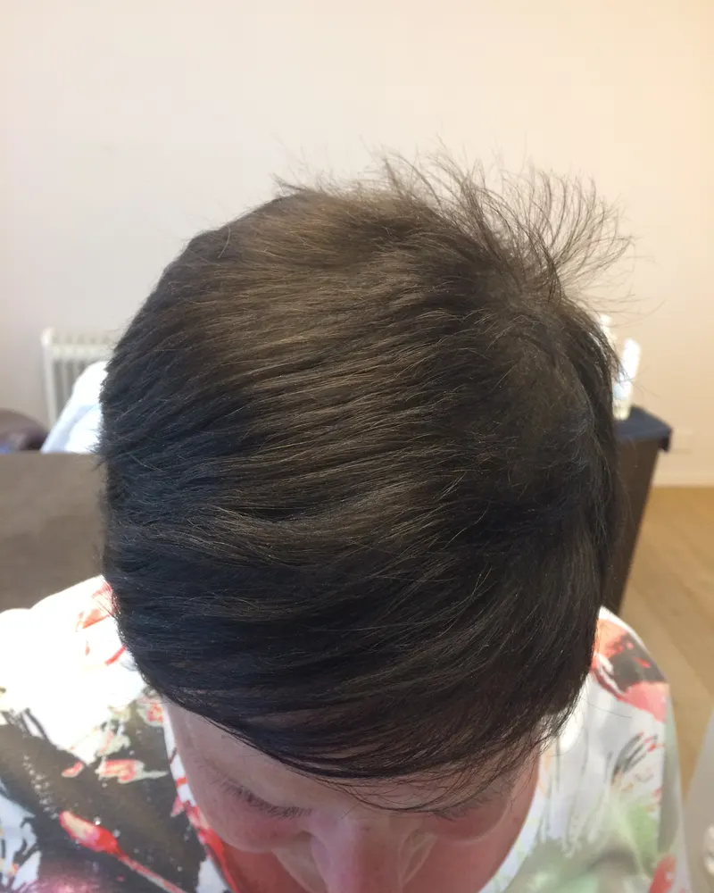 Dezelfde persoon na de behandeling, met voller bruin haar