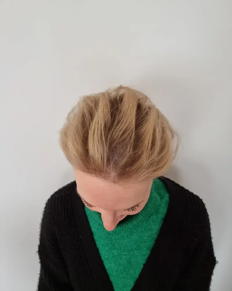 Dezelfde vrouw na de behandeling, met vollere scheiding