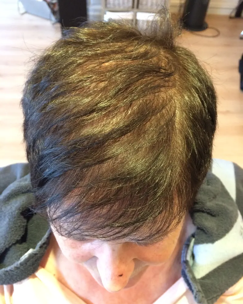 Persoon met dunner wordend bruin haar voor de behandeling