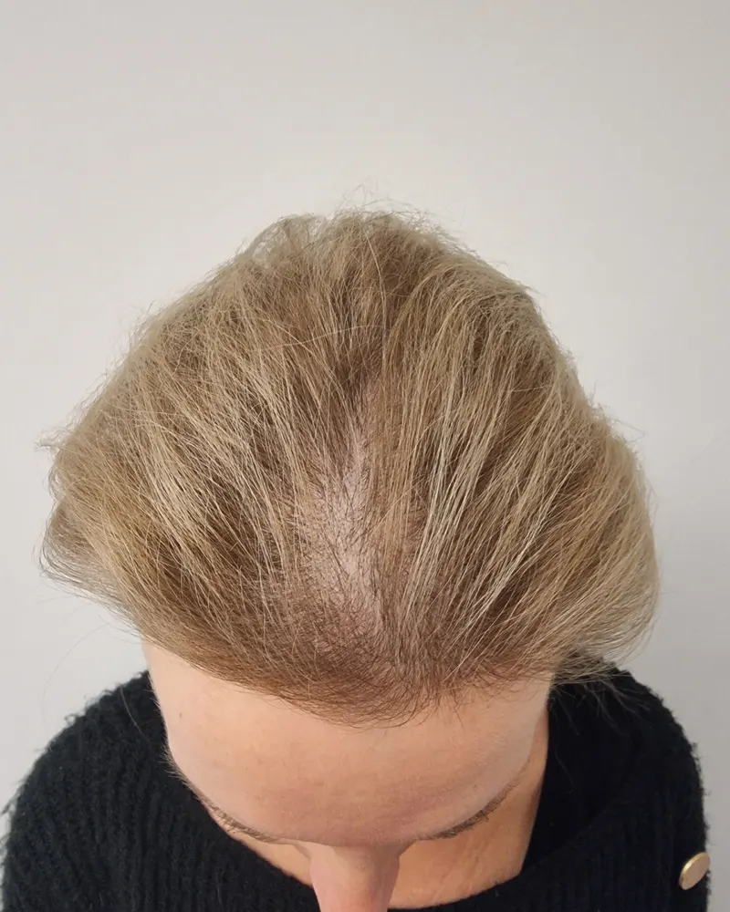 Vrouw met uitgedund blond haar en brede scheiding voor de behandeling