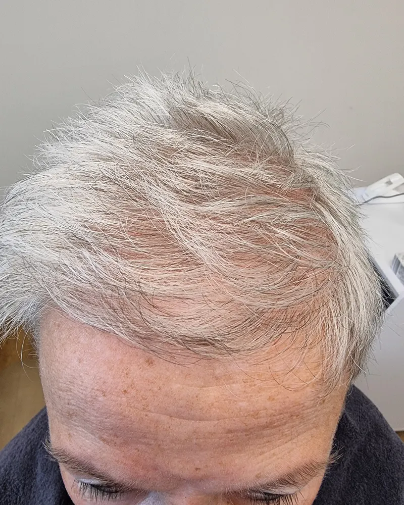 Vrouw met dunner wordend grijs haar voor de behandeling